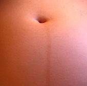Linear, vertical brown patch inferior to umbilicus on the abdomen of a pregnant woman
