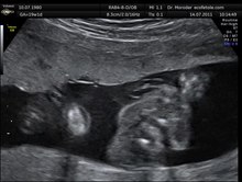 File:Urinating male fetus Dr. Wolfgang Moroder.theora.ogv