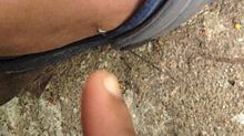 File:Mosquito biting on leg.webm