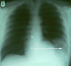 Diaphragmatic rupture spleen herniation.jpg
