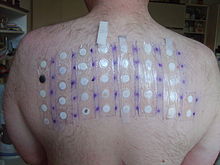 five by seven patch test on medical subjects upper back
