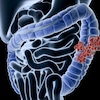 Illustration médicale numérique d'une perspective radiographique d'un cancer colorectal.