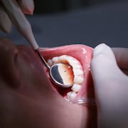 Gros plan d'une bouche ouverte avec miroir chez le dentiste.
