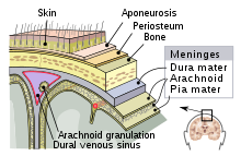 Diagram showing the three layers of the meninges: the dura mater (blue), arachnoid mater (green) and pia mater (fawn)