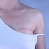 Une femme arbore une cicatrice sur le sein gauche en raison d'une chirurgie.