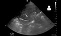 File:UOTW 34 - Ultrasound of the Week 1.webm