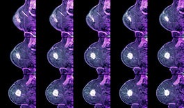 Breast cancer MRI scans