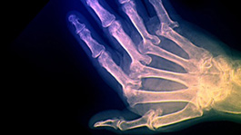 Arthritic hand - Copyright: Zephyr/Science Photo Library