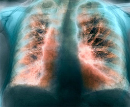 Fibrosing alveolitis - Copyright: Science Photo Library