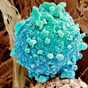 Alt: Skin cancer cell - Copyright: STEVE GSCHMEISSNER / SCIENCE PHOTO LIBRARY