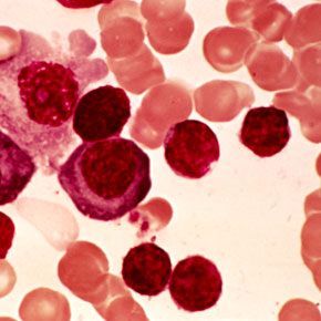 Alt: Lymphoplasmacytic lymphoma, micrograph - Copyright: PR. J. BERNARD/CNRI/SCIENCE PHOTO LIBRARY