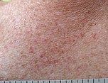 Itchy rash. Small erythematous spots are observed.